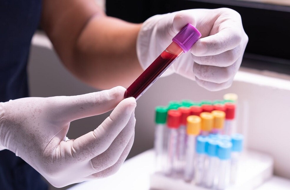 Simple blood test improves bipolar disorder diagnosis; Researchers