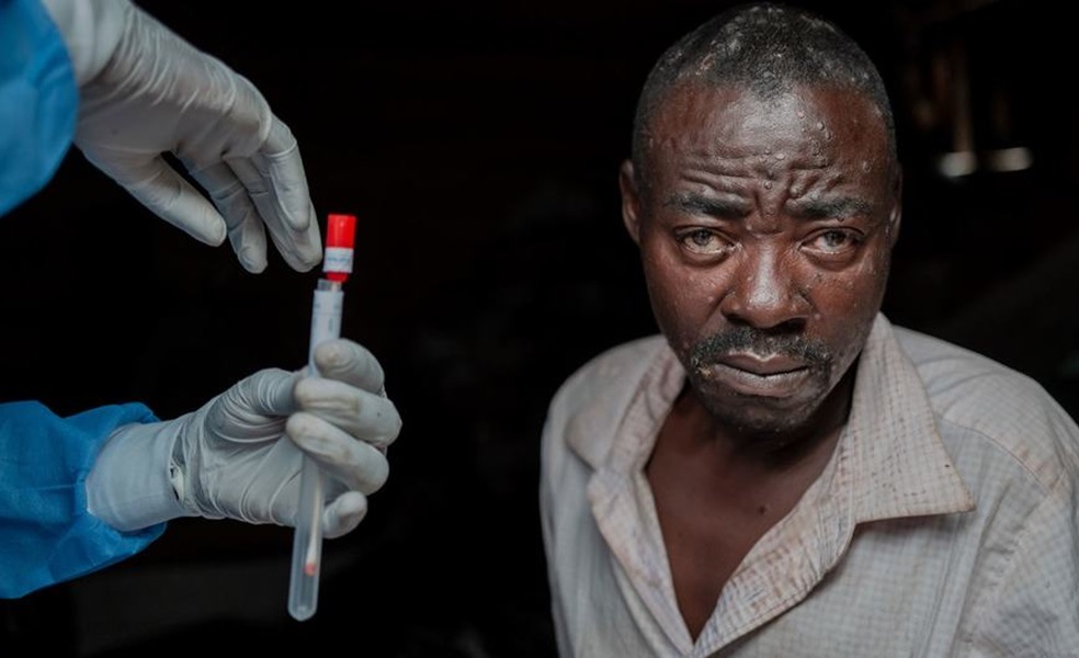 mpox vaccine administering