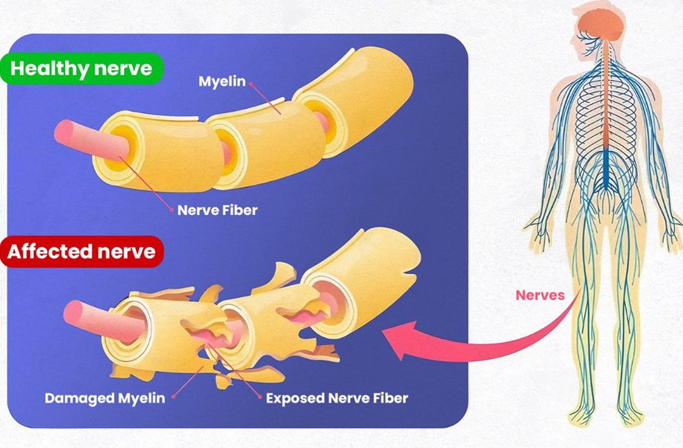 India faces surge in GBS cases_Image Via_Ministry of Health India