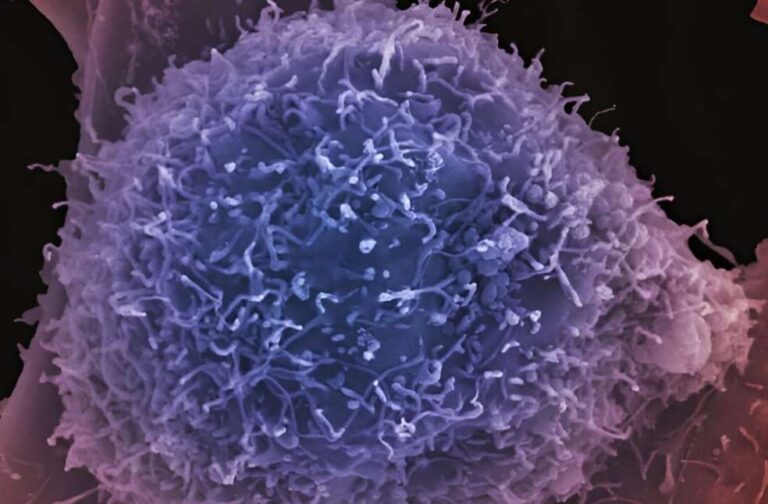 Artificial intelligence test that can accurately predict which men with prostate cancer