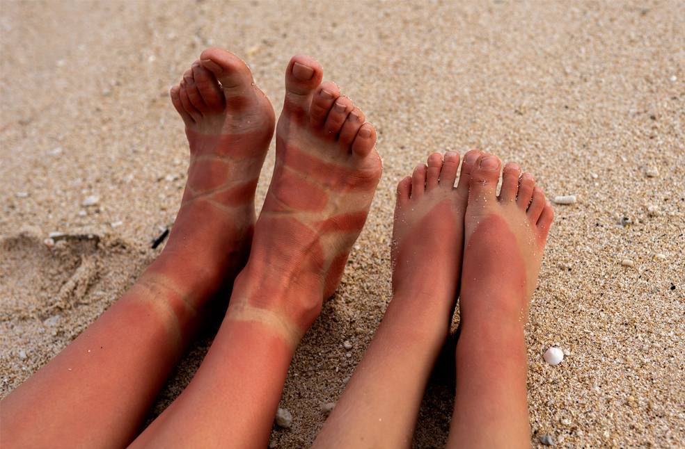 Experts warn of sunburn risks_Image from_Freepik