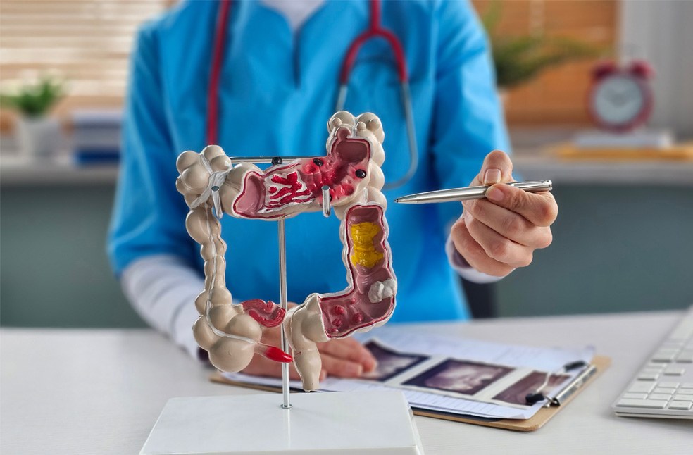 Model of Bowel Cancer explained by a medical professional