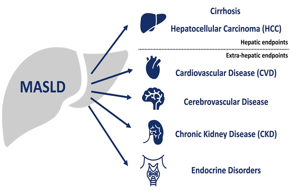 MASLD surge globally-Image Via-Lancet