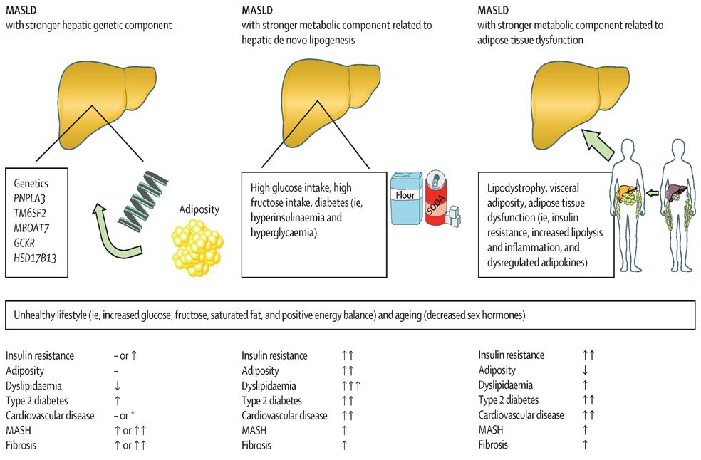 MASLD surge globally-Image from-Lancet