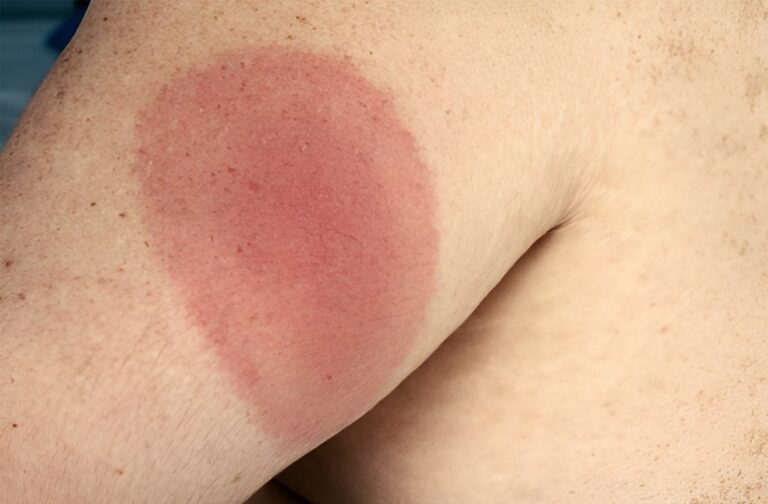 England records 22% rise in Lyme Disease cases Lyme Disease England-NHS Reform