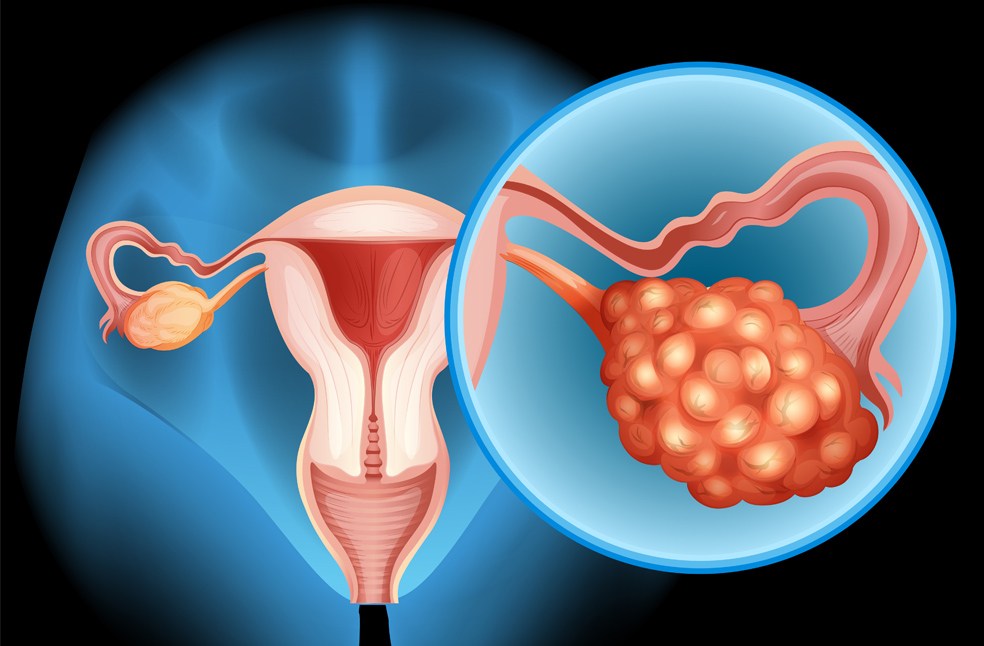 Ovarian Cancer concept