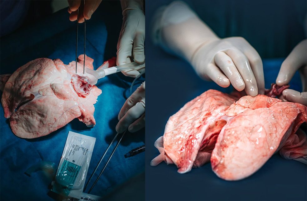 Machine save Donated Lungs in UK-Image Via-XVIVO
